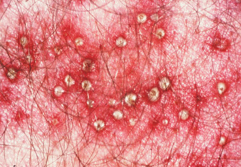 Fungal Folliculitis Pictures