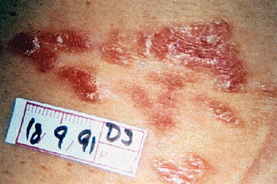 secondary stage syphilis
