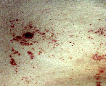 petechiae pinpoint red dots on skin